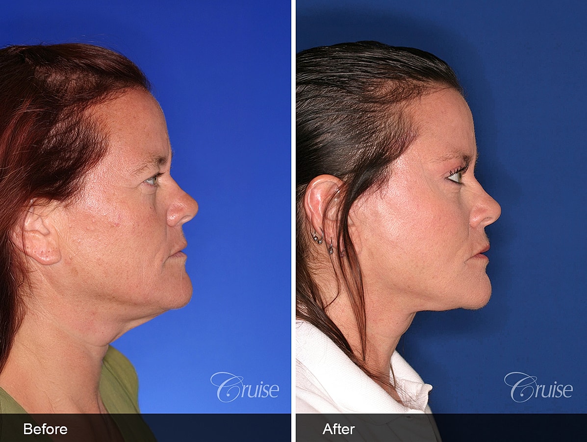 Face Lift Before & After