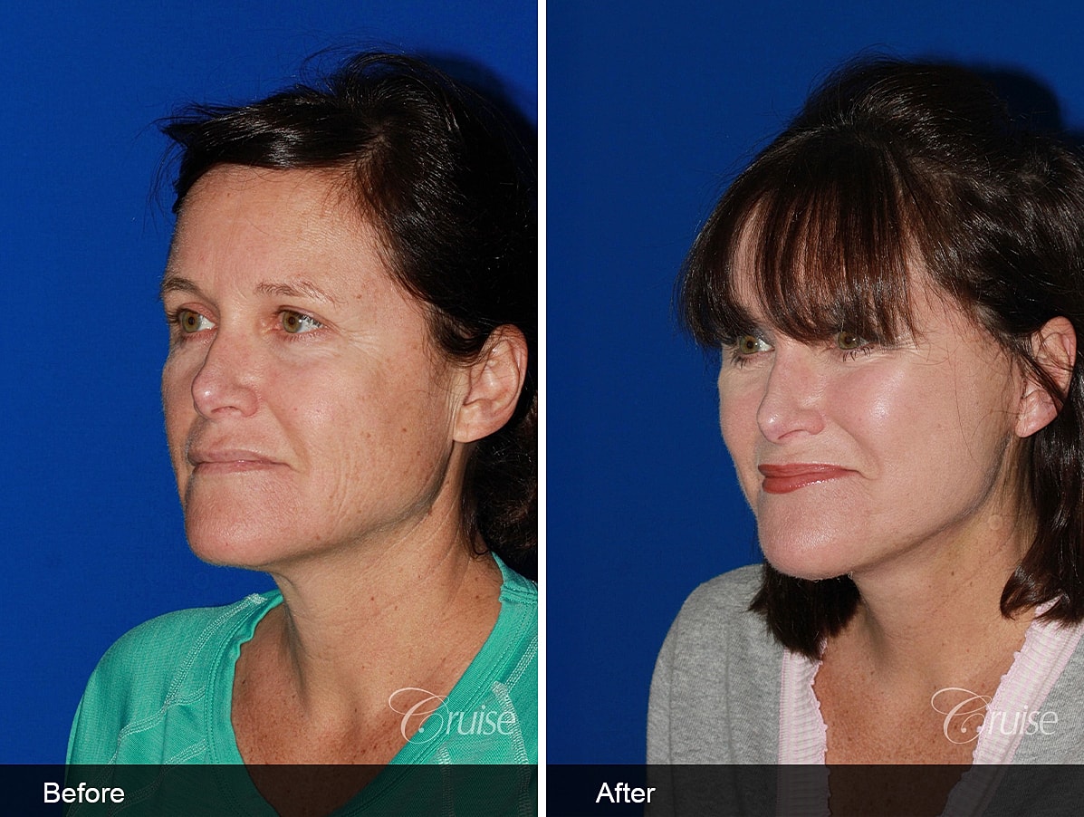 Face Lift Before & After