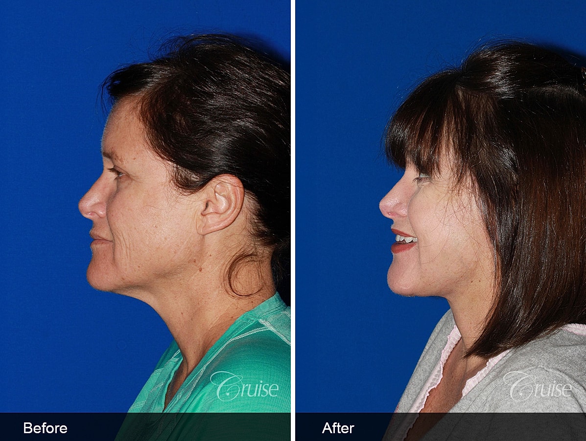 Face Lift Before & After