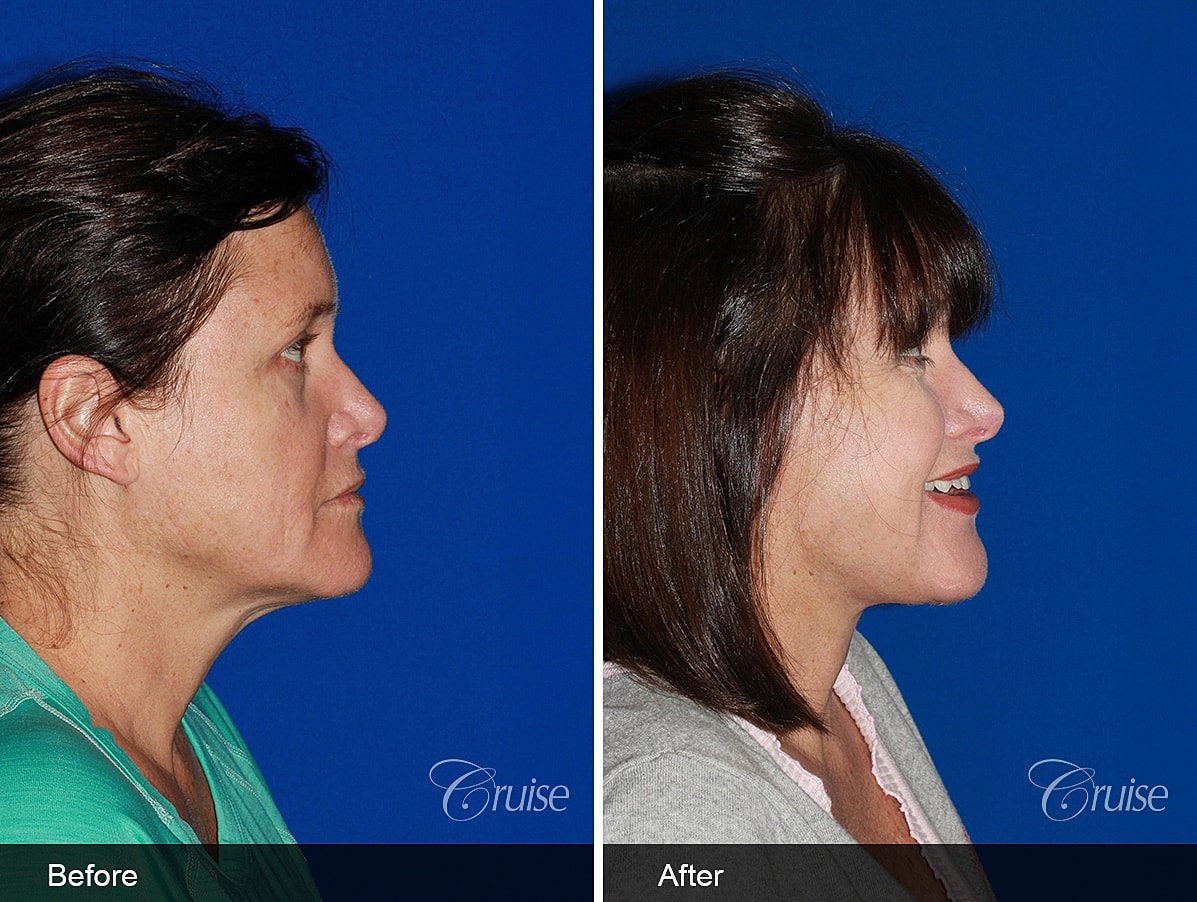 Face Lift Before & After