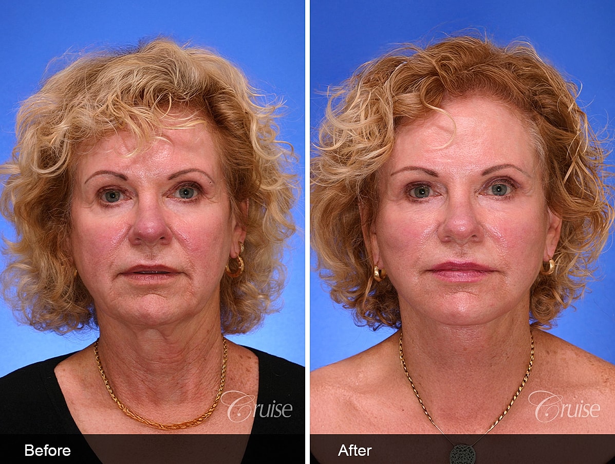 Face Lift Before & After
