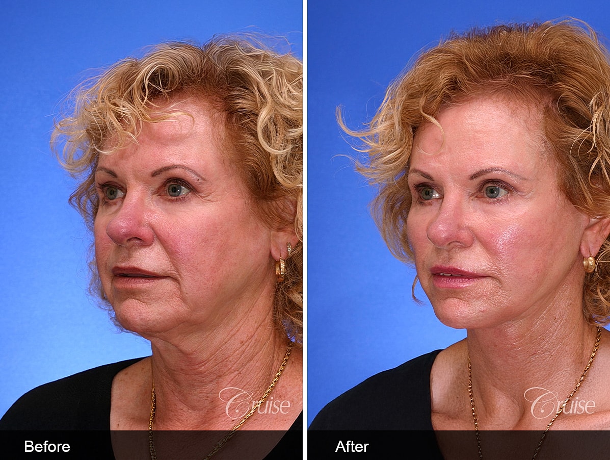 Face Lift Before & After