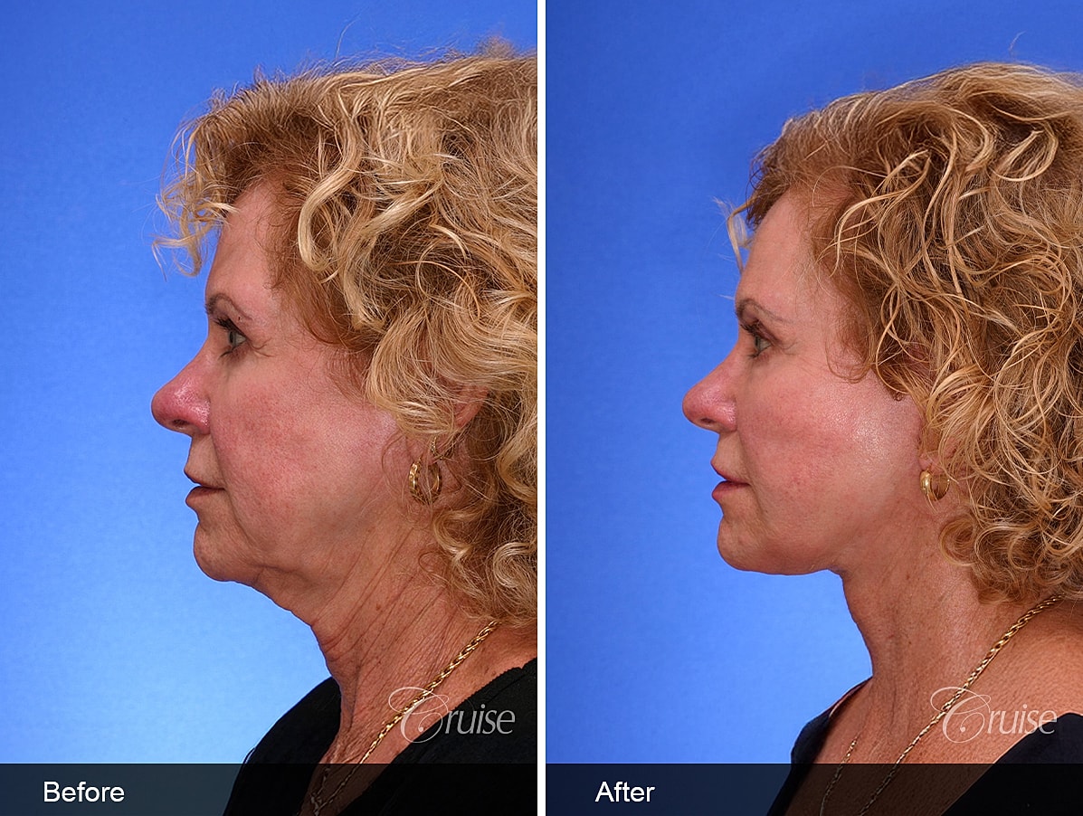 Face Lift Before & After