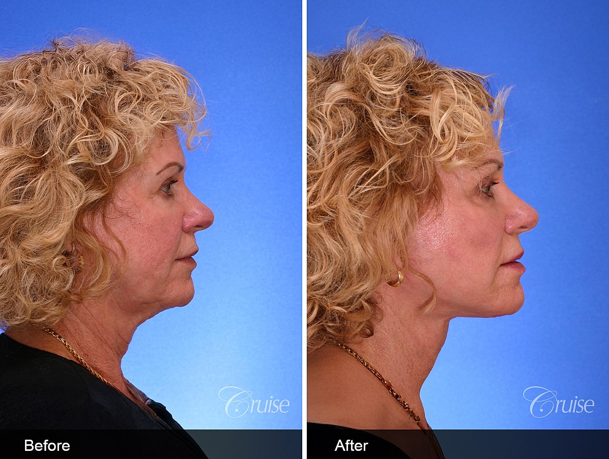Face Lift Before & After