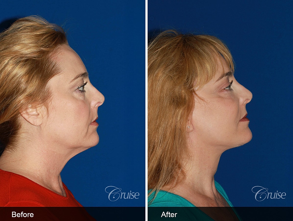 Face Lift Before & After