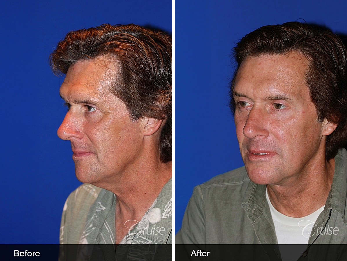 Face Lift Before & After