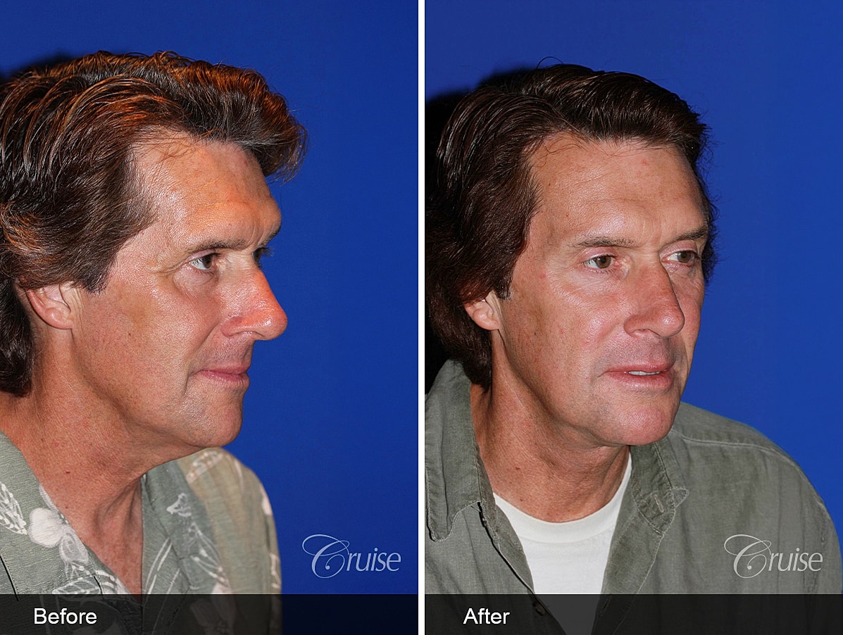Face Lift Before & After