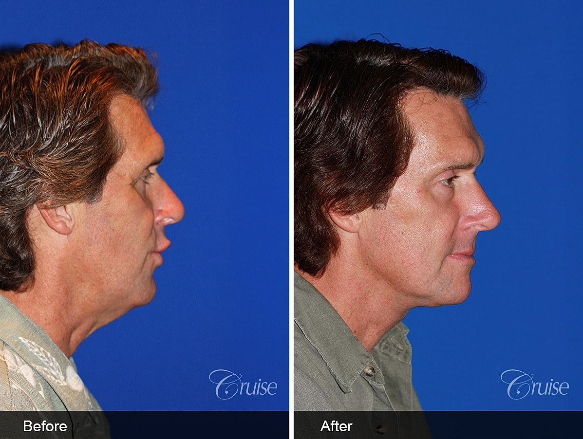 Face Lift Before & After