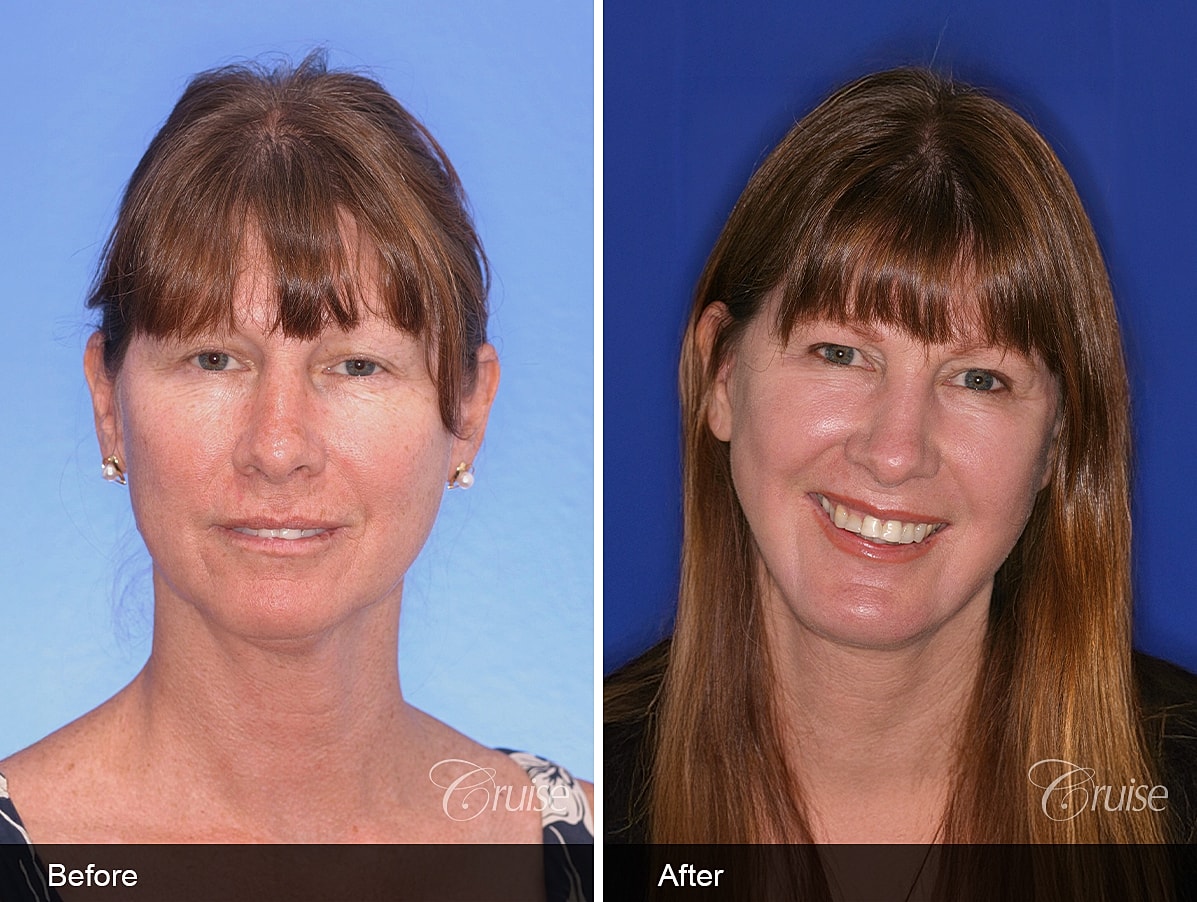Face Lift Before & After