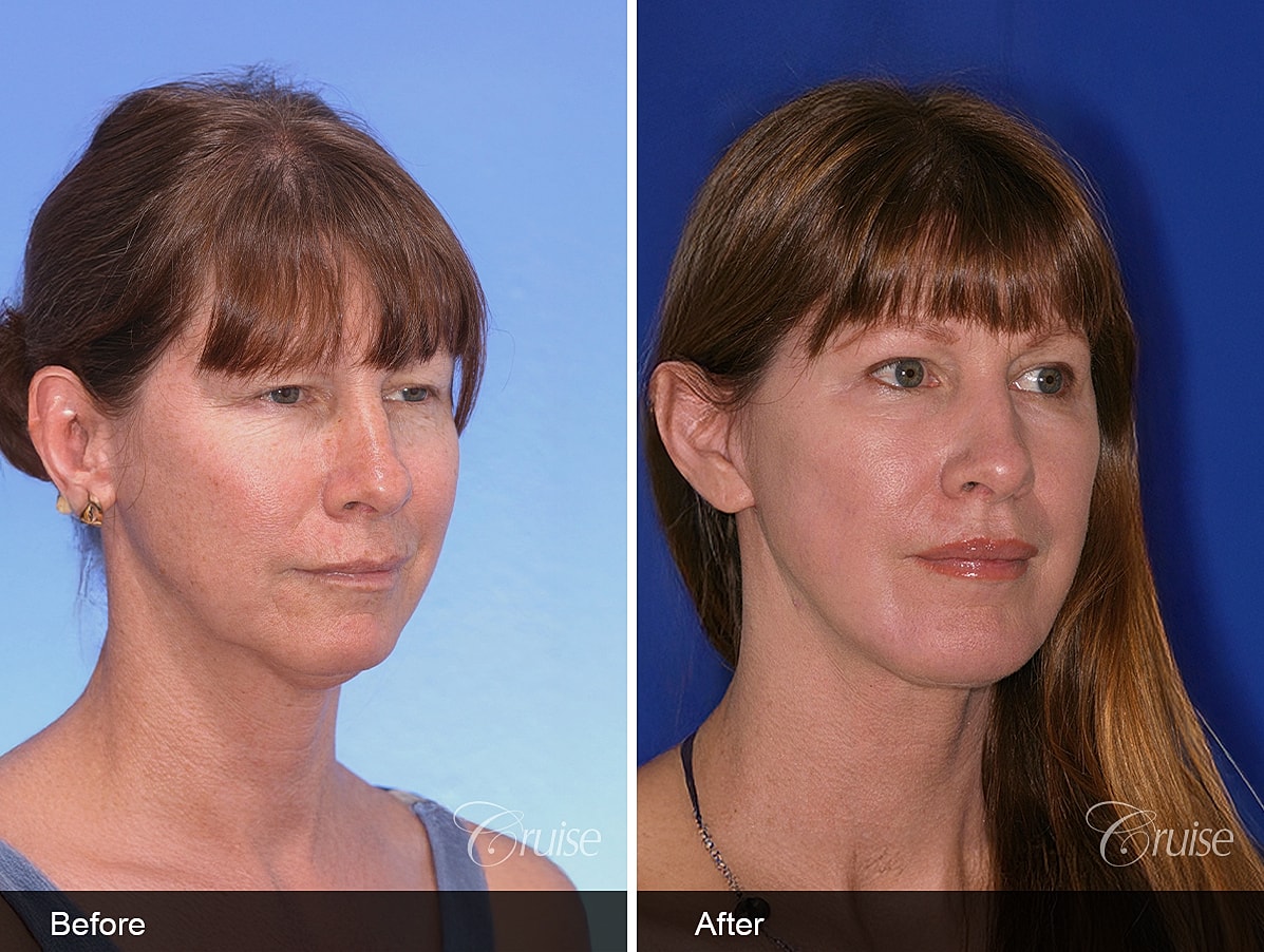 Face Lift Before & After