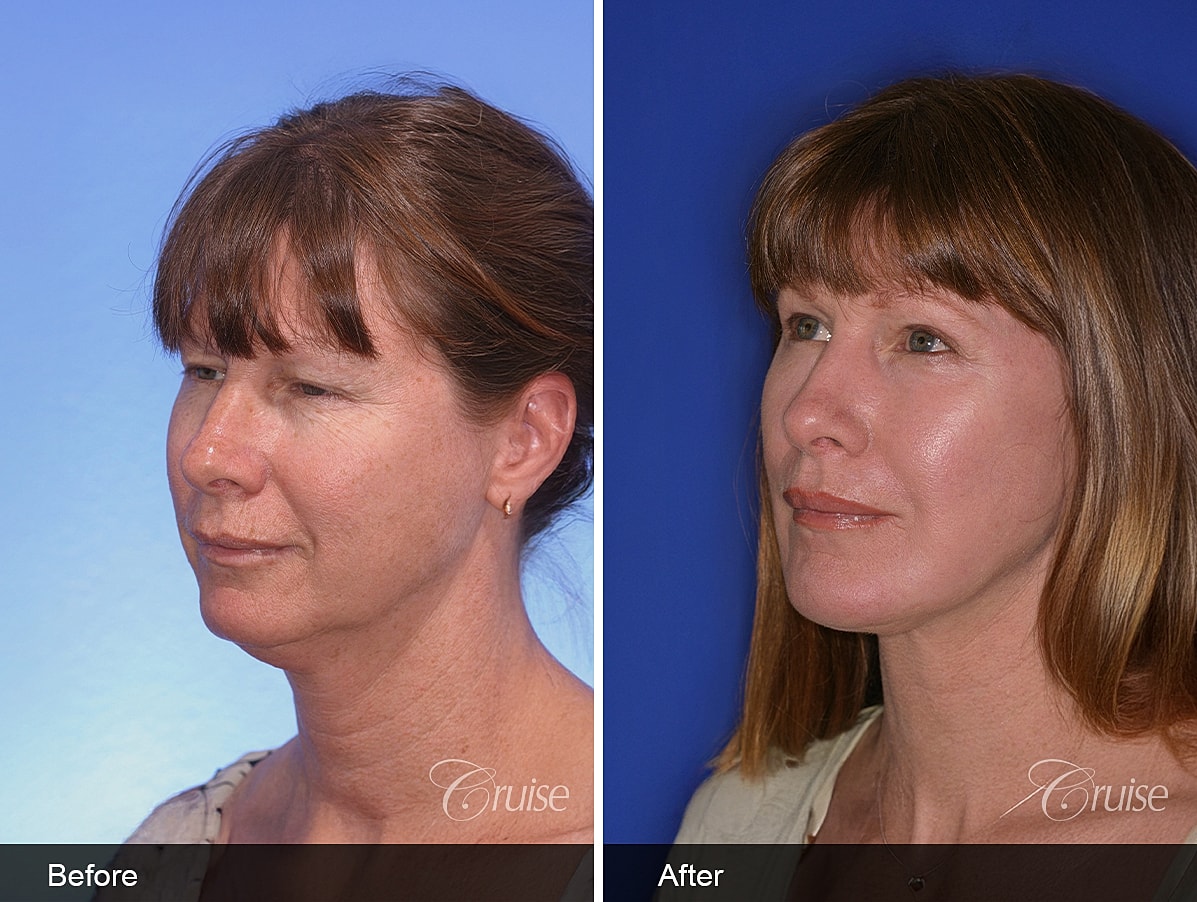 Face Lift Before & After