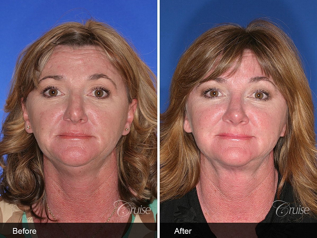 Face Lift Before & After