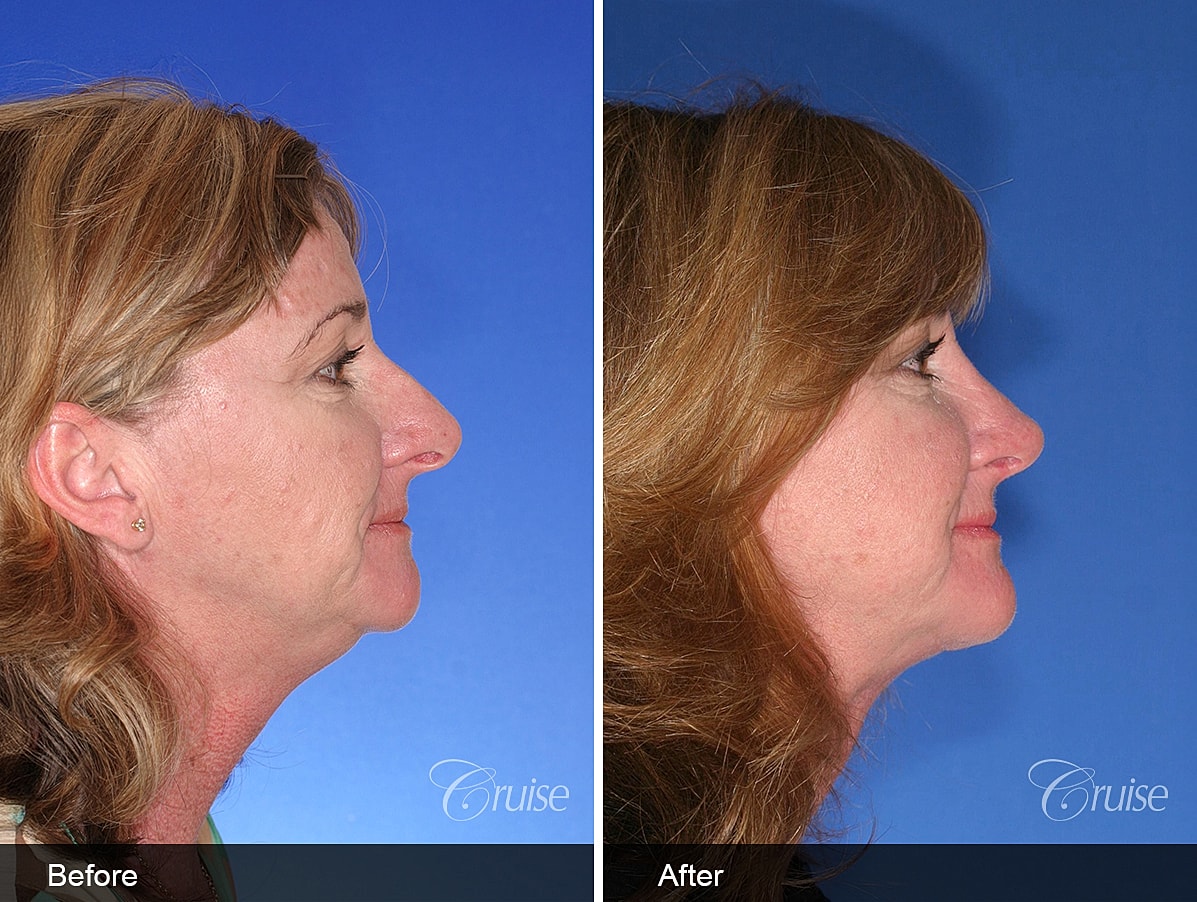 Face Lift Before & After