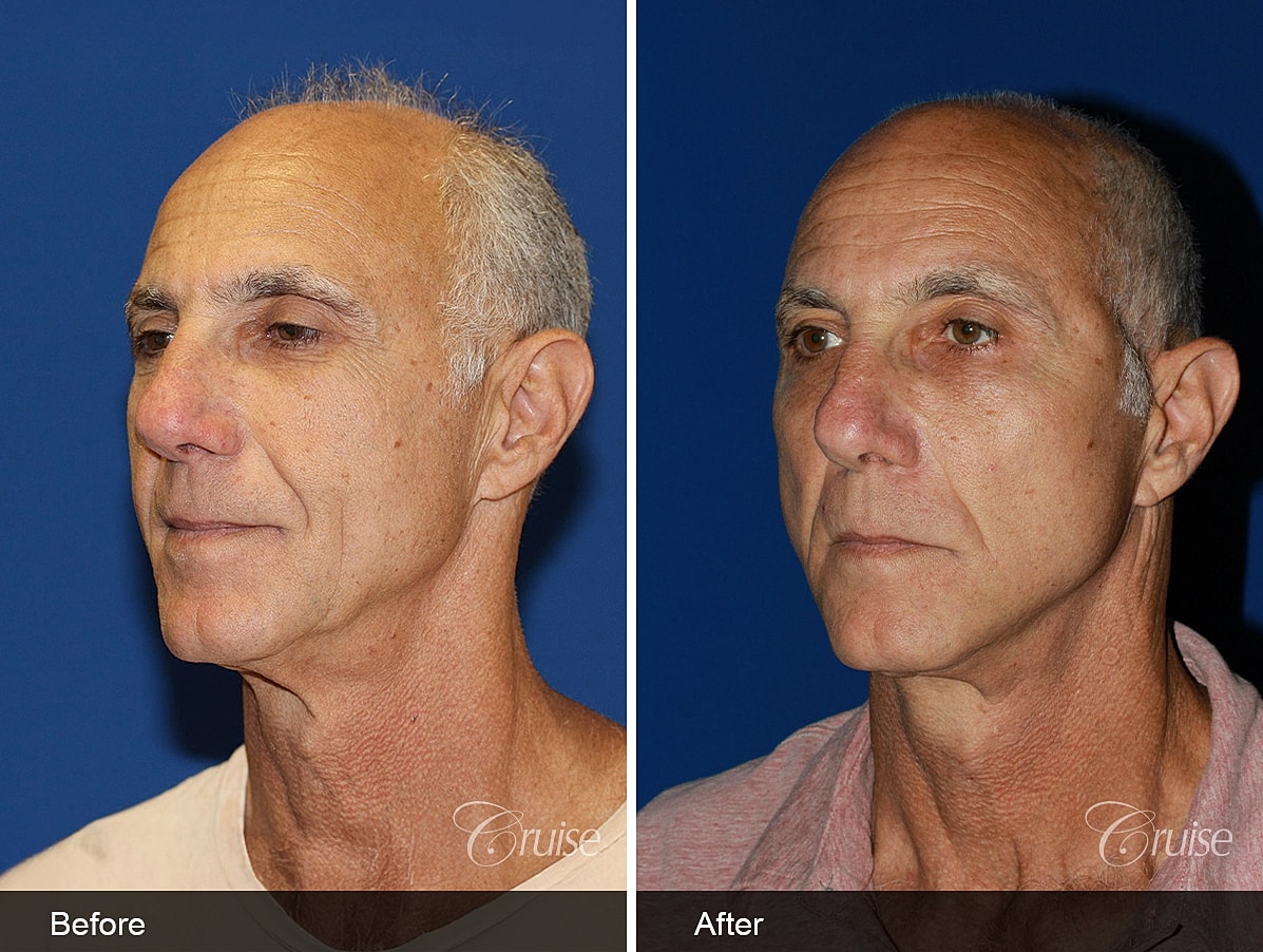 Face Lift Before & After