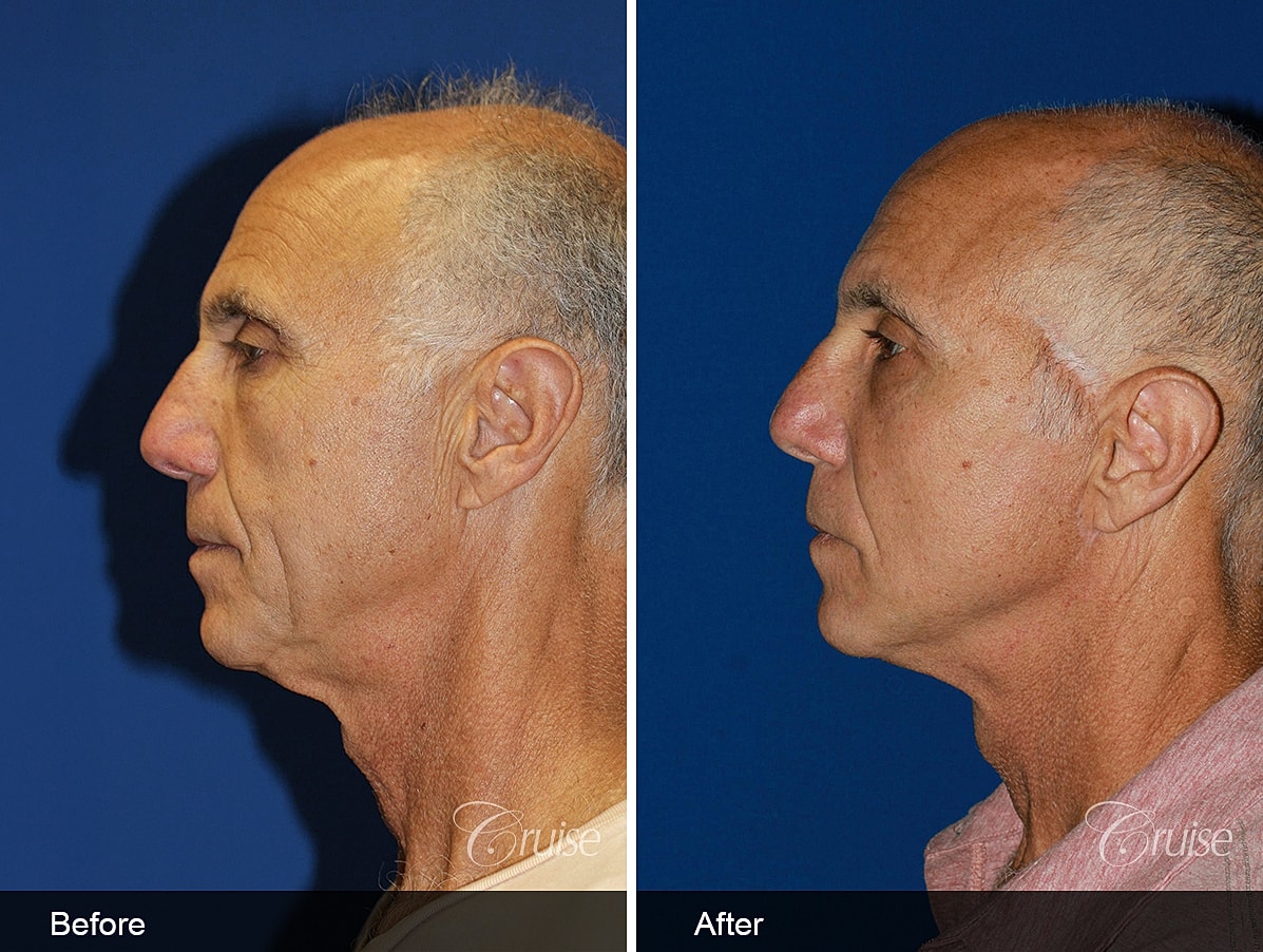 Face Lift Before & After