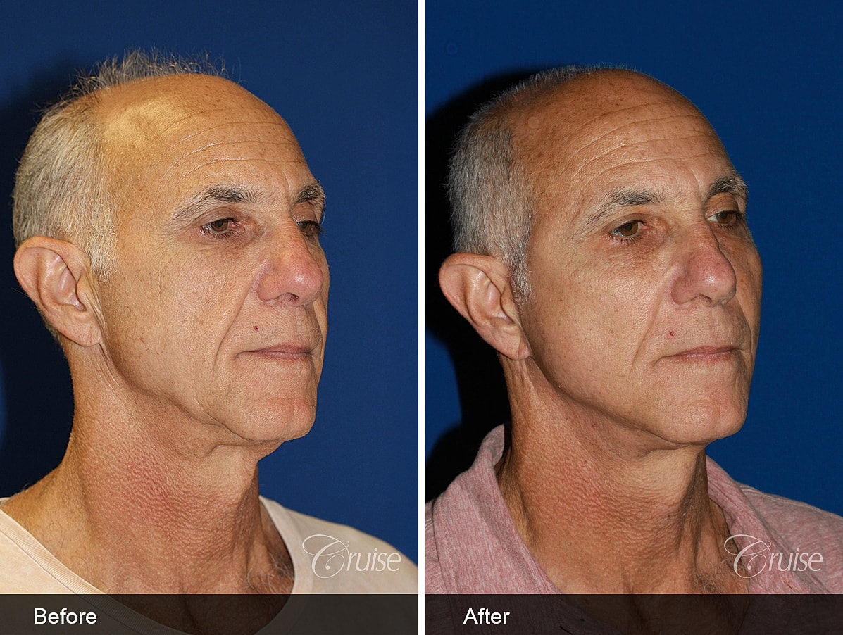 Face Lift Before & After