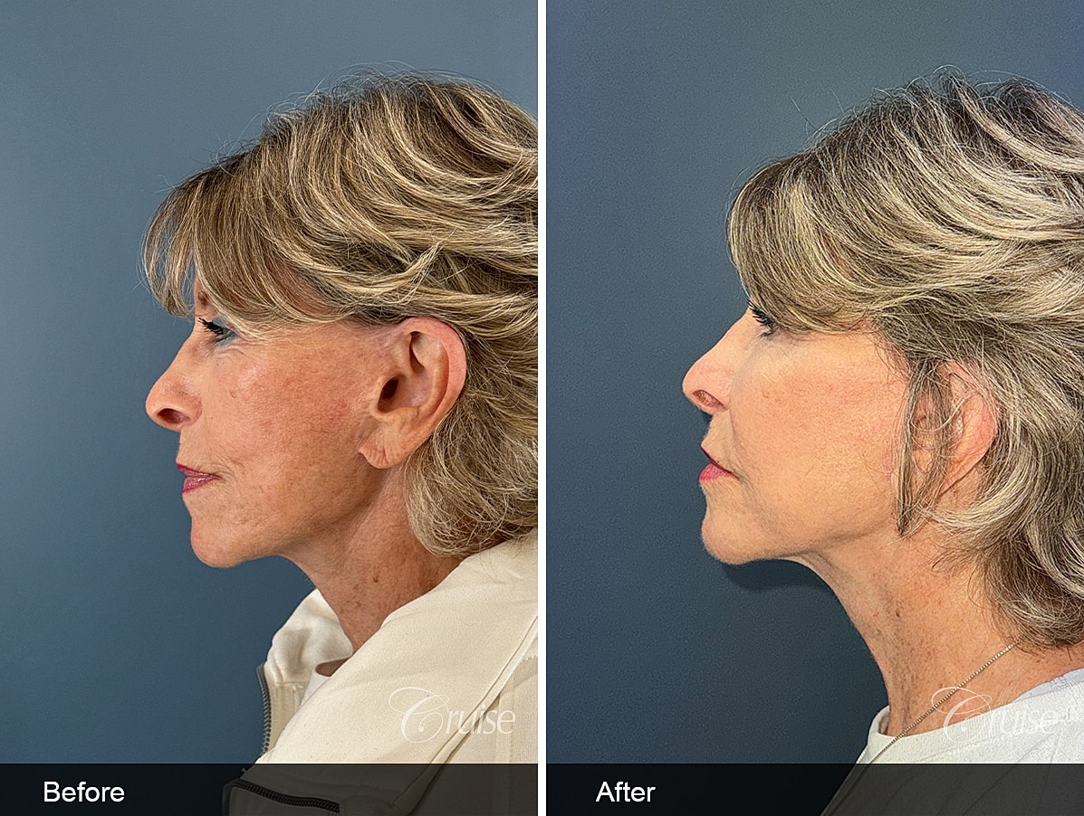 Face Lift Before & After