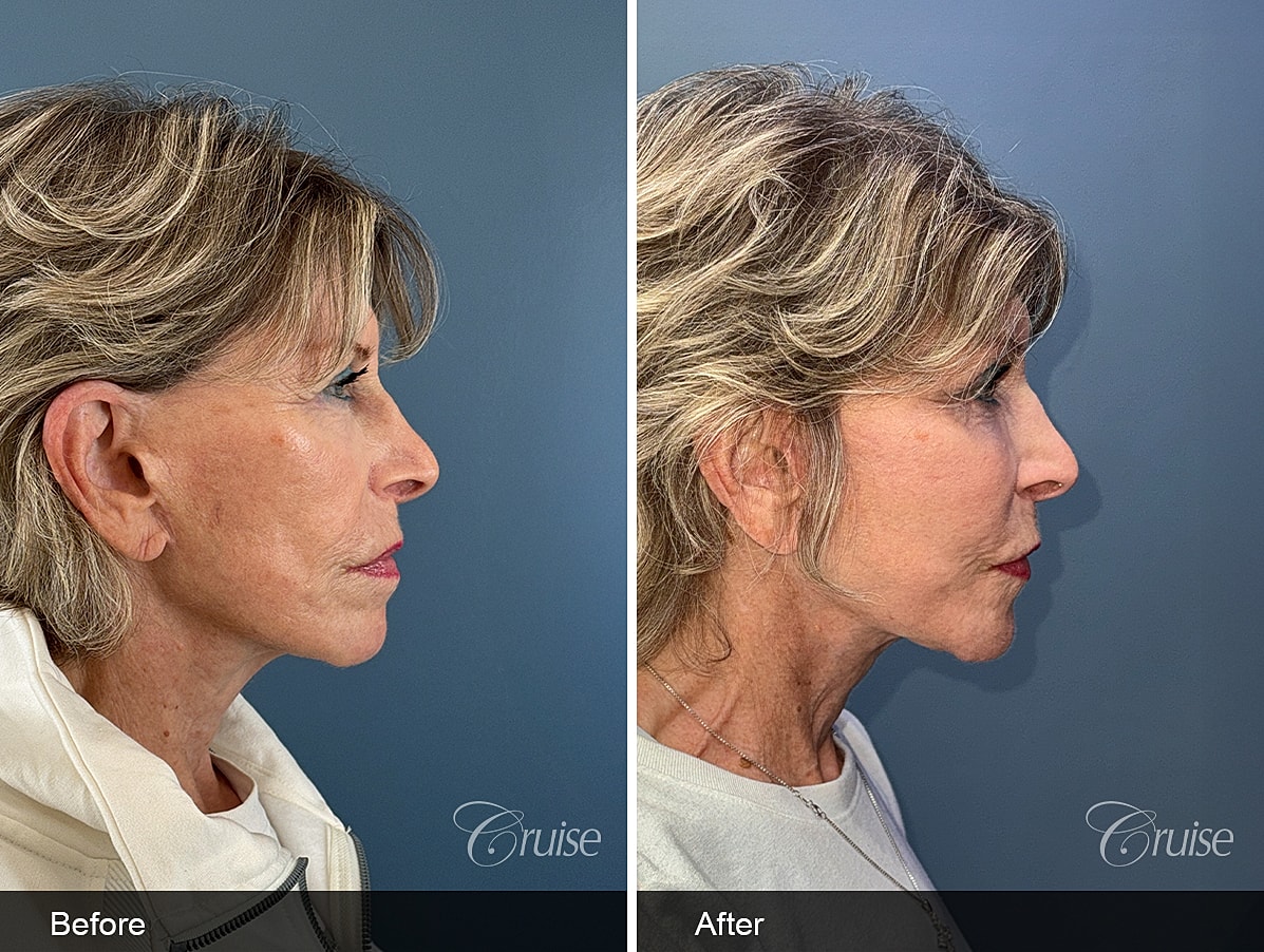 Face Lift Before & After