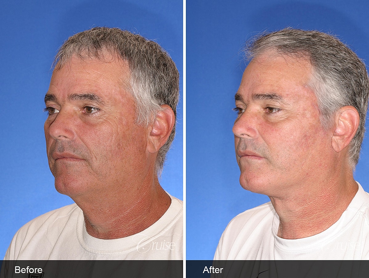 Face Lift Before & After