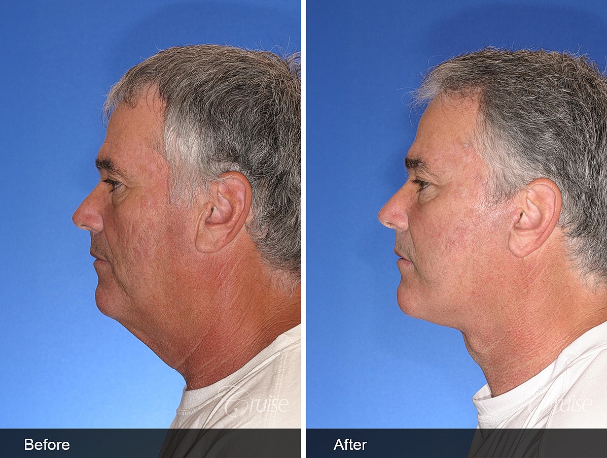 Face Lift Before & After