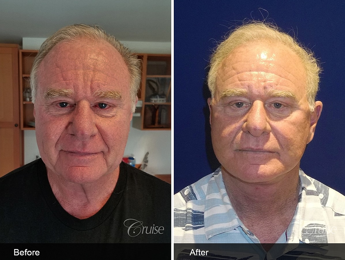 Face Lift Before & After