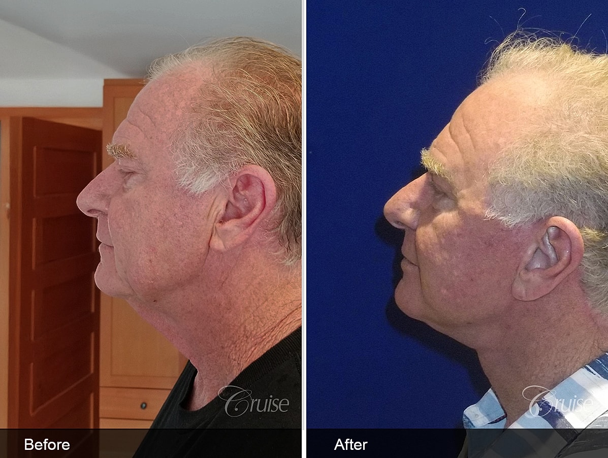 Face Lift Before & After