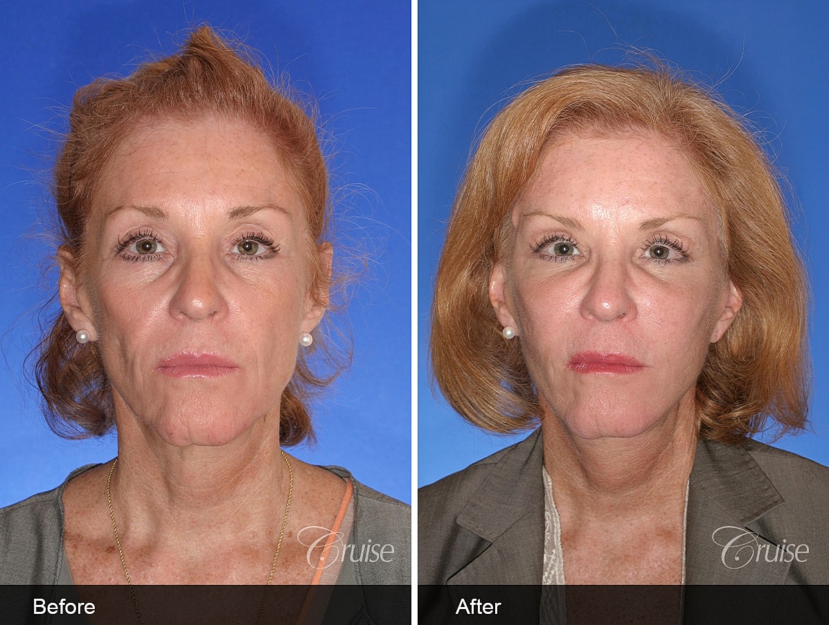 Face Lift Before & After