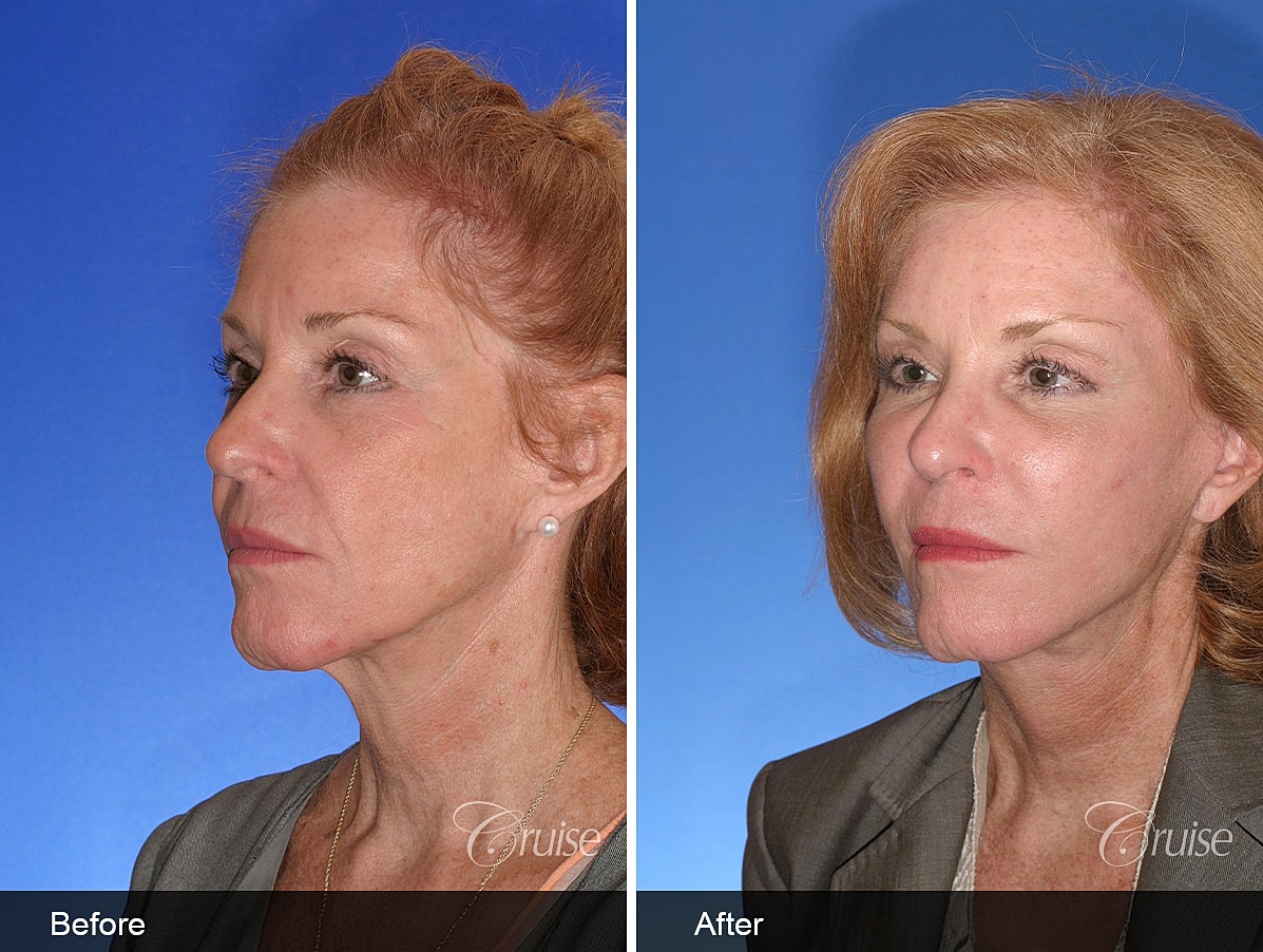 Face Lift Before & After