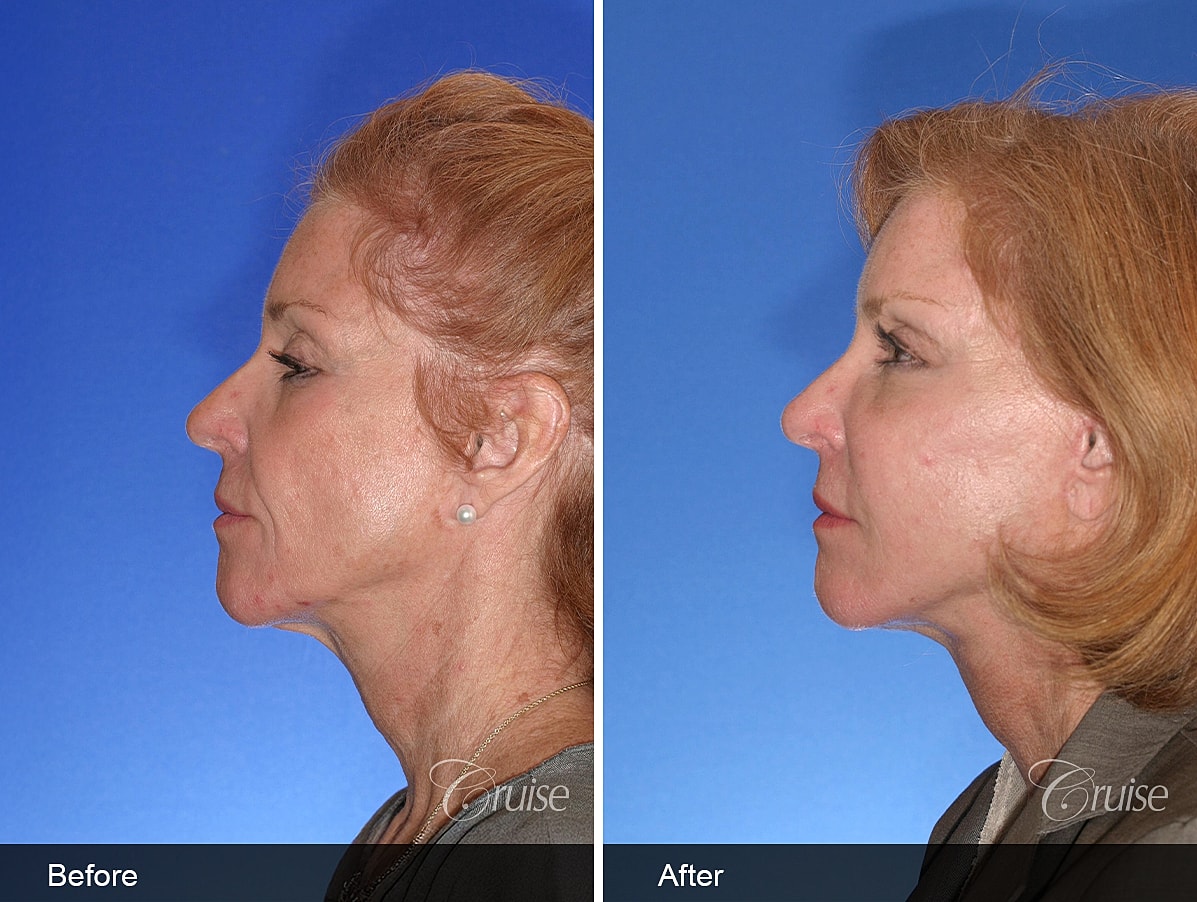 Face Lift Before & After
