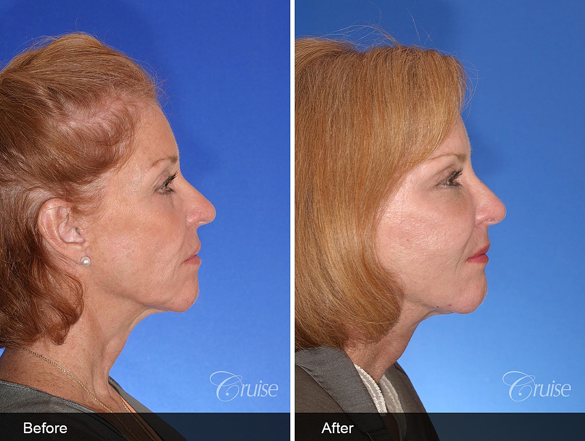 Face Lift Before & After