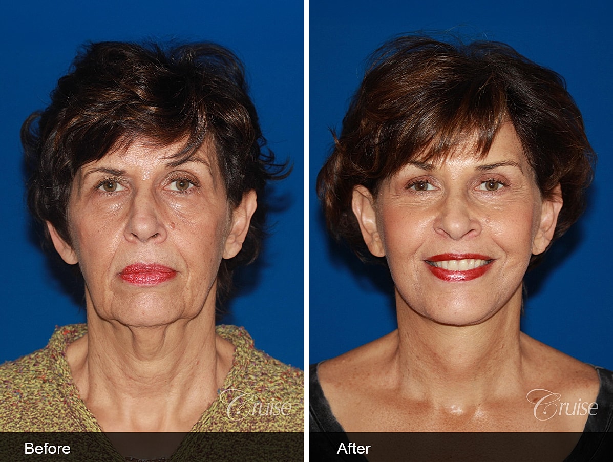 Face Lift Before & After