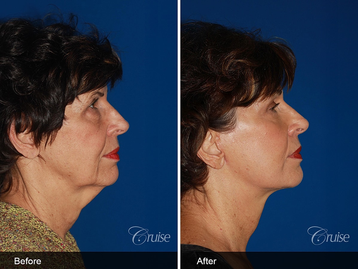 Face Lift Before & After