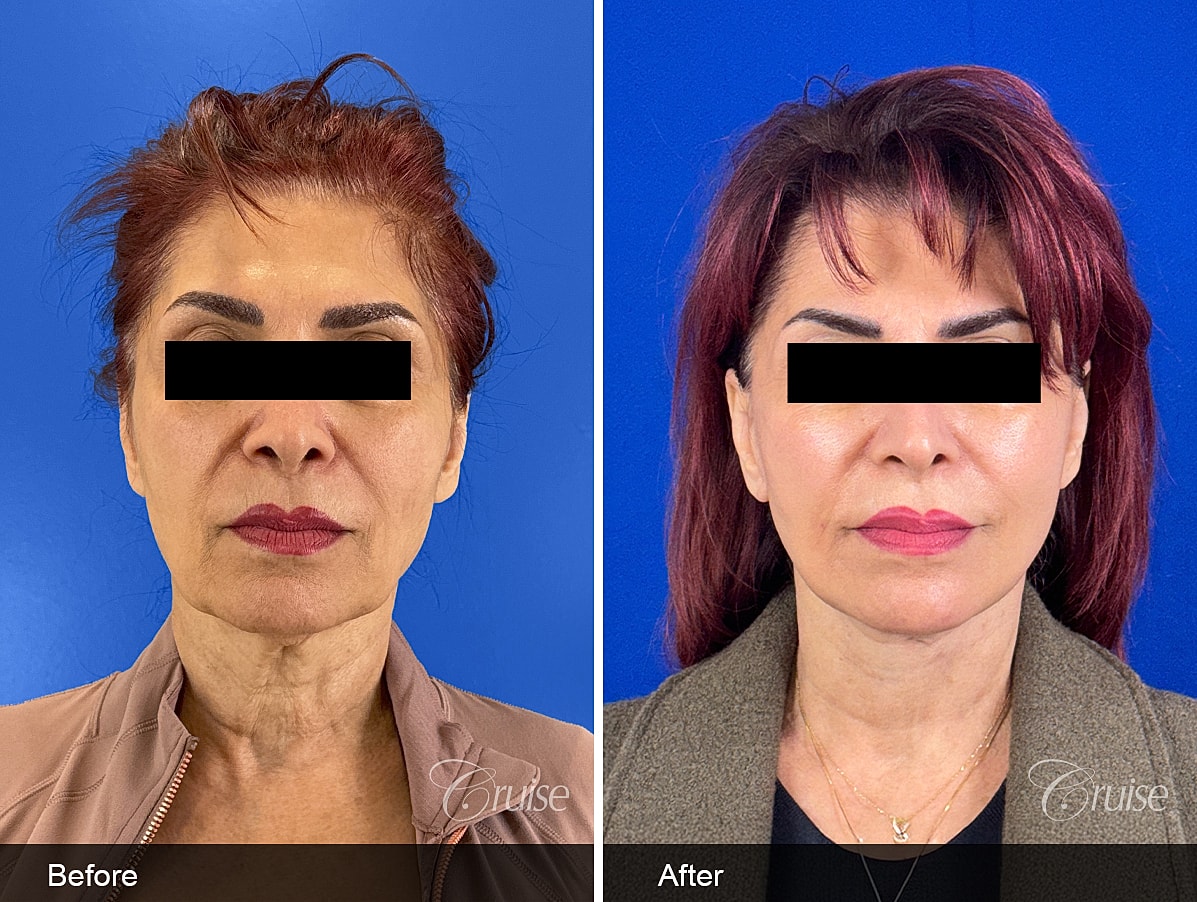 Face Lift Before & After