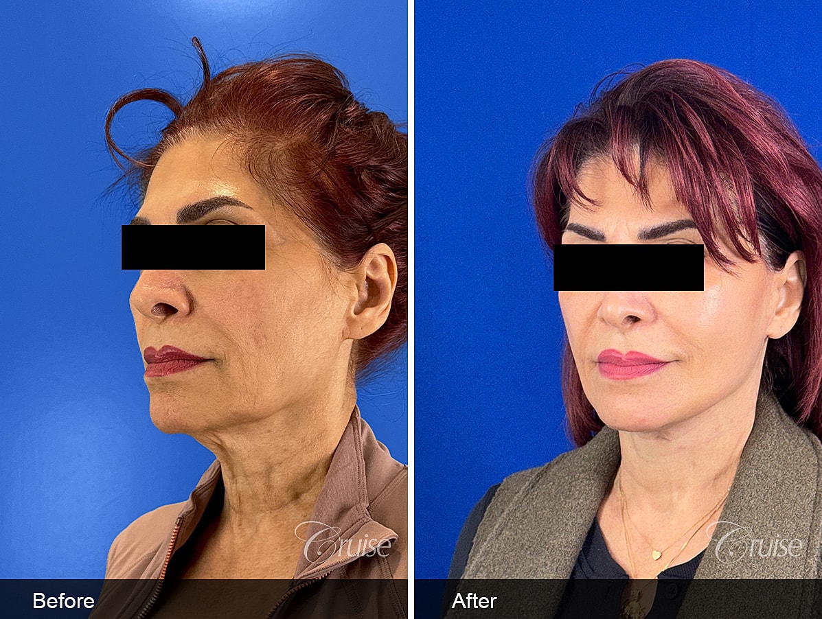 Face Lift Before & After