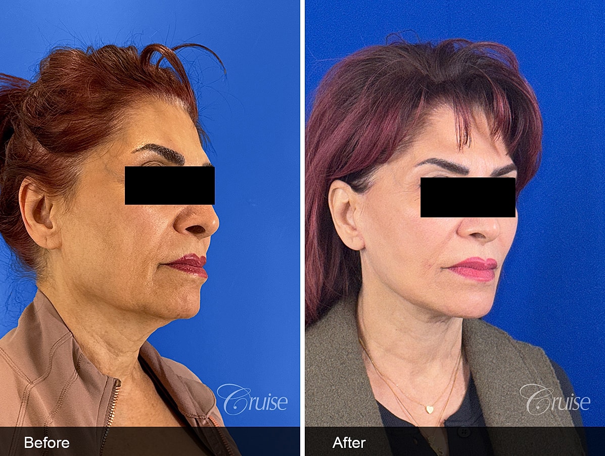 Face Lift Before & After