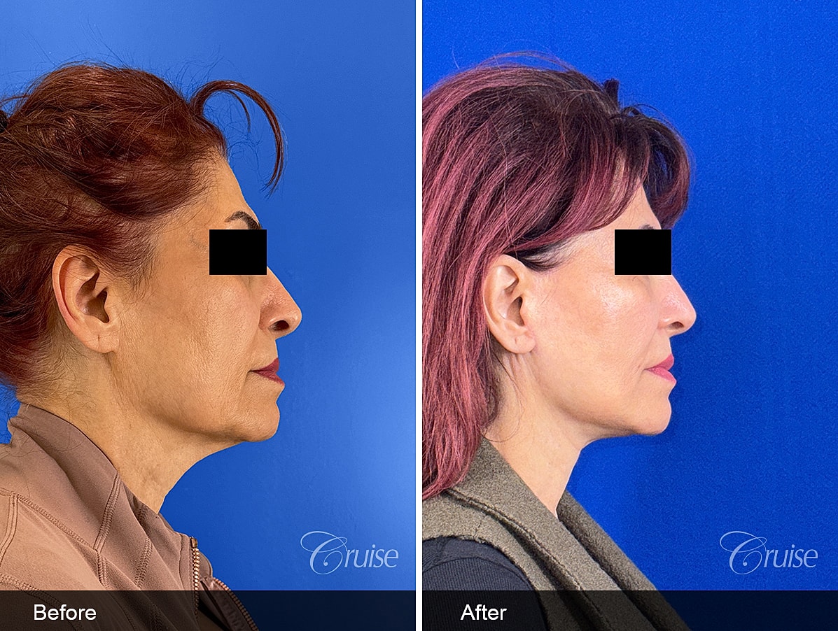 Face Lift Before & After