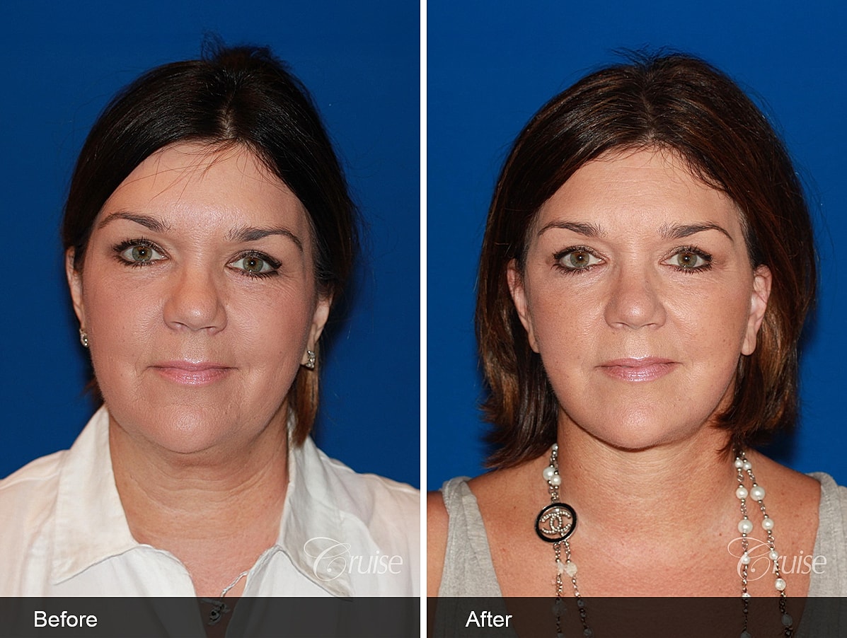 Face Lift Before & After