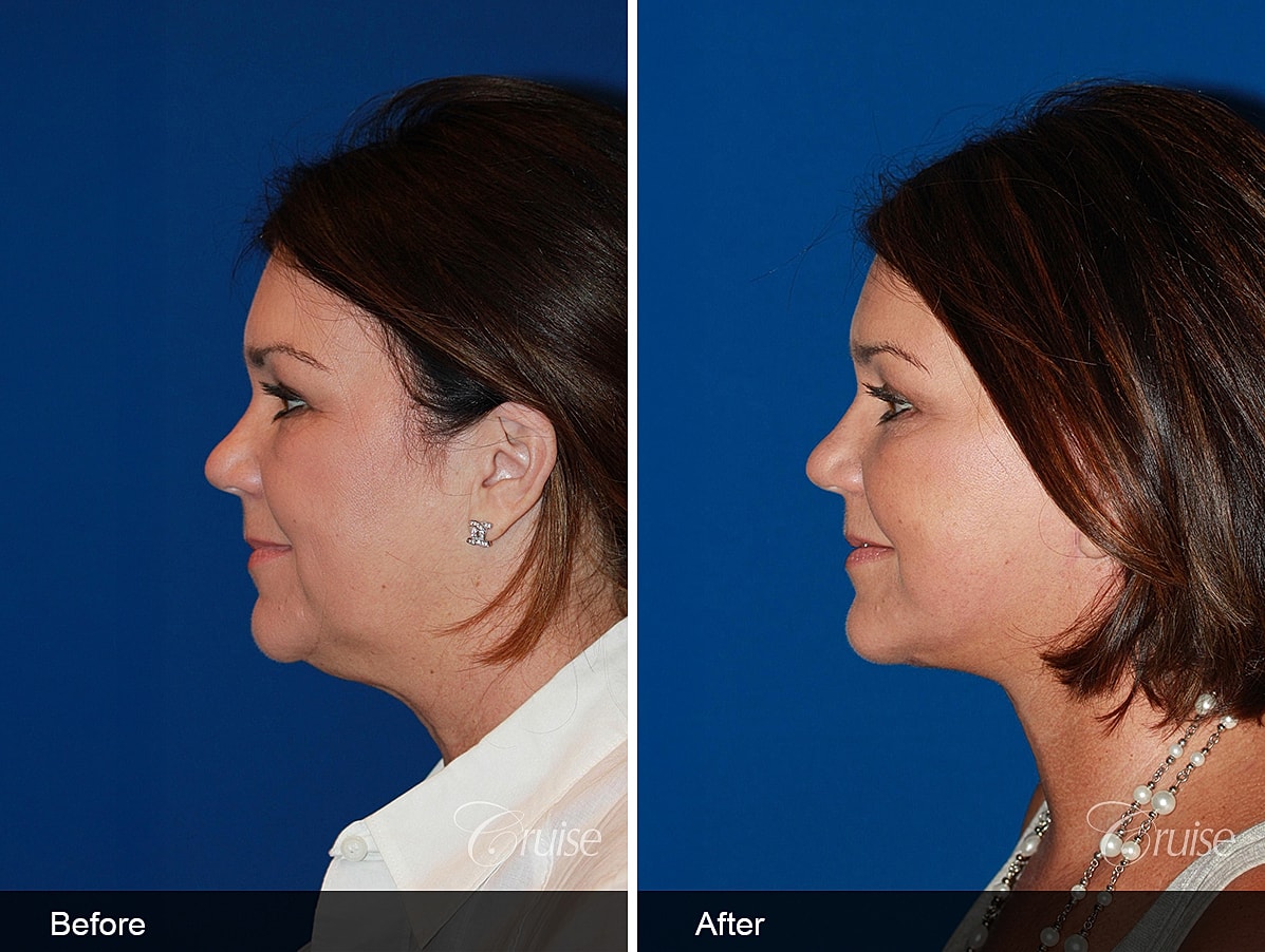 Face Lift Before & After