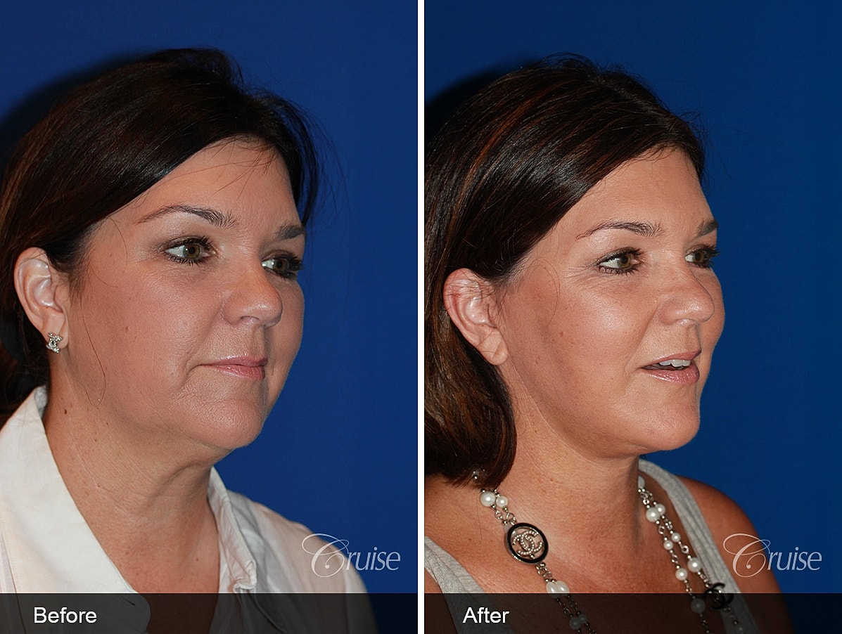 Face Lift Before & After