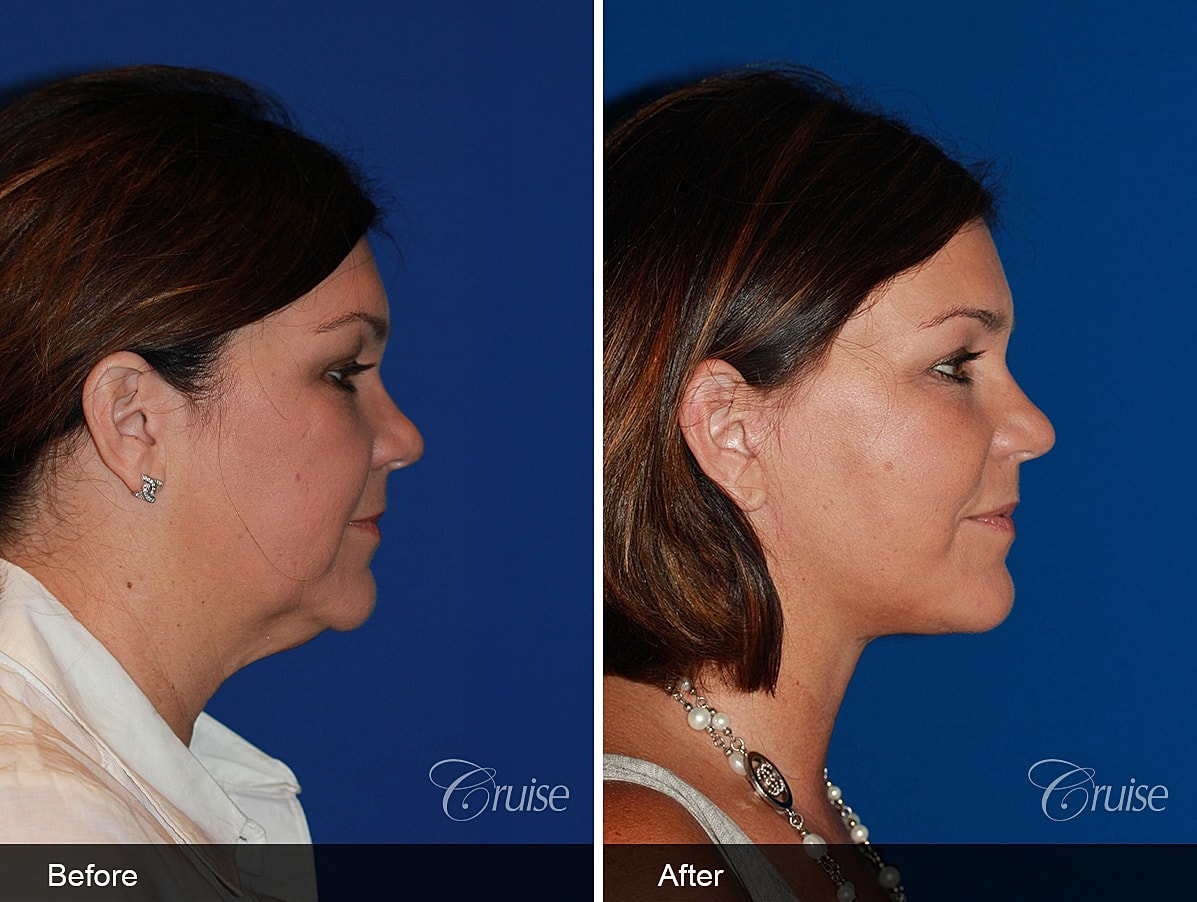 Face Lift Before & After