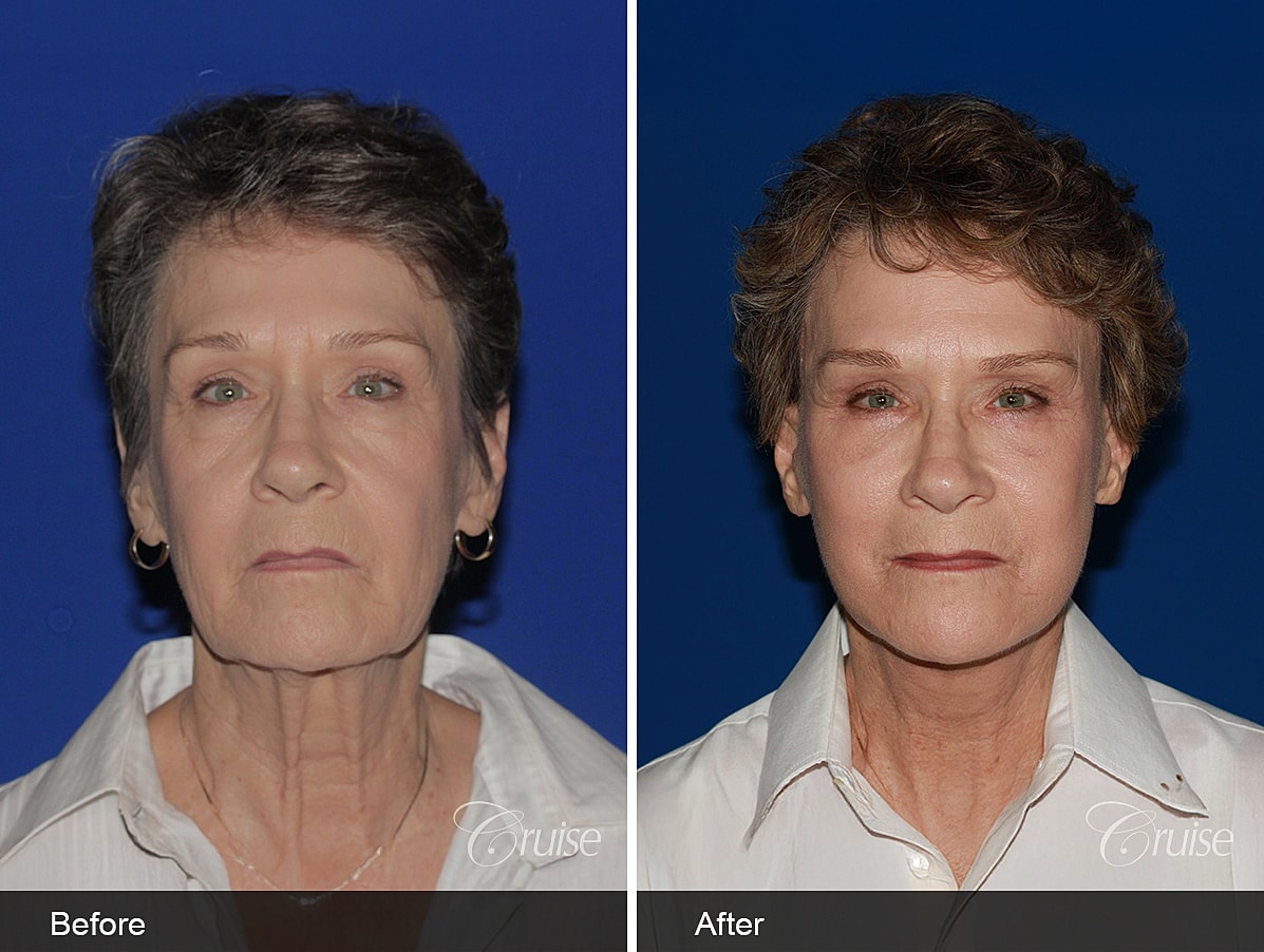 Face Lift Before & After