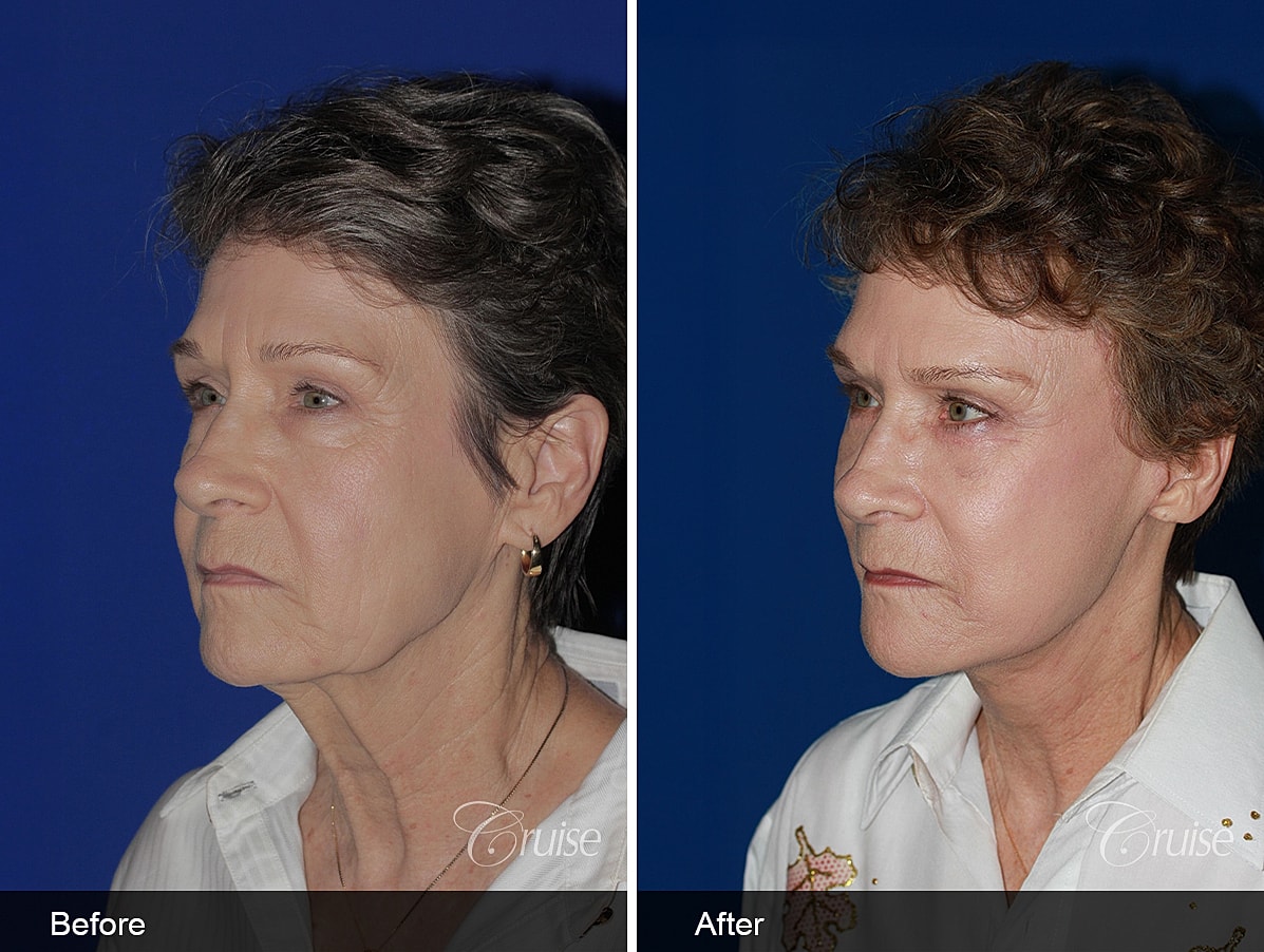Face Lift Before & After