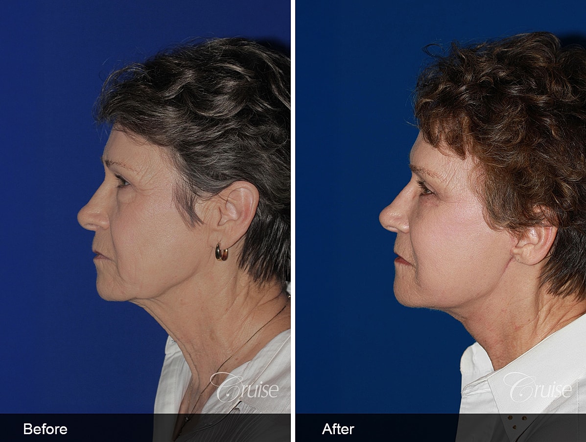 Face Lift Before & After