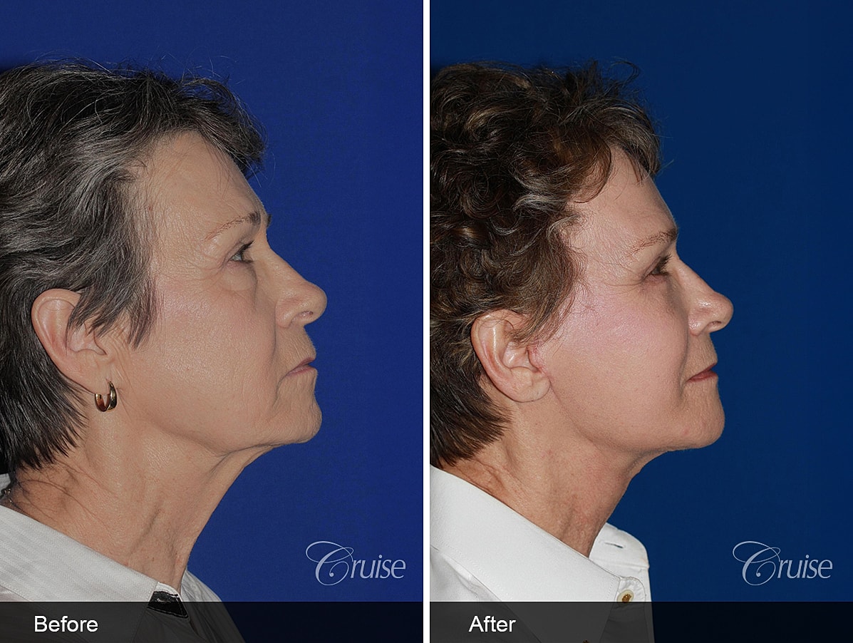 Face Lift Before & After