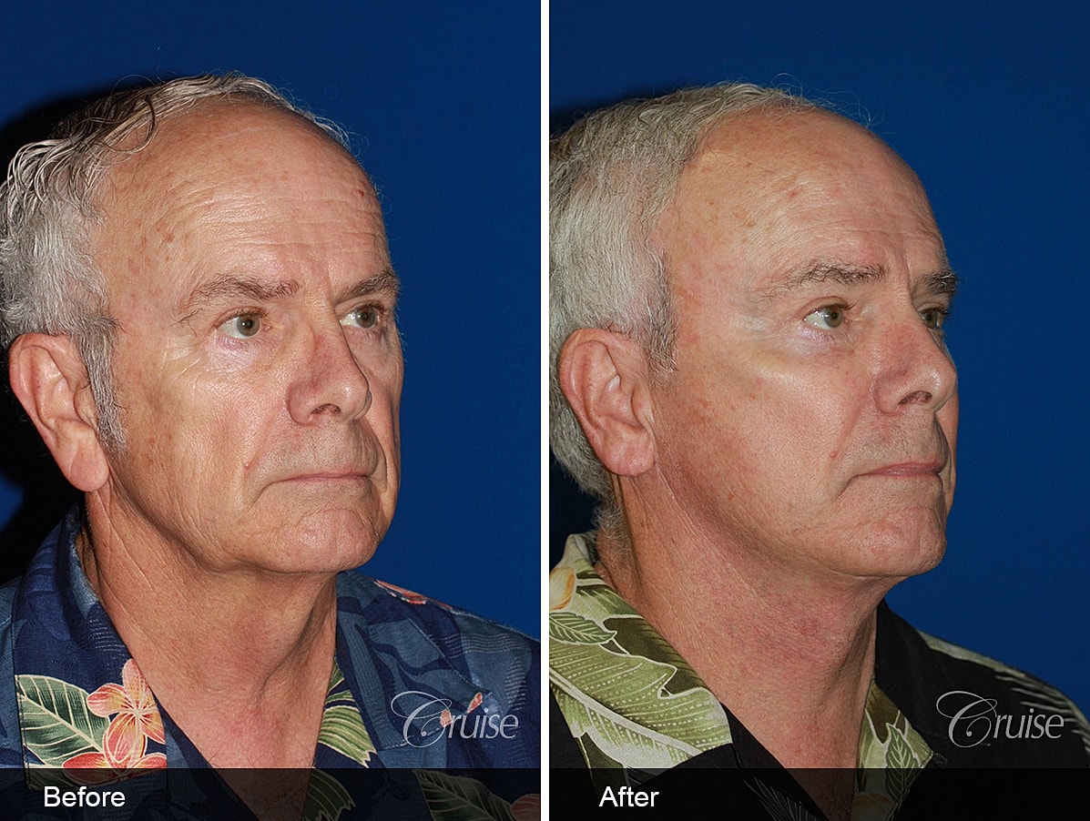 Face Lift Before & After