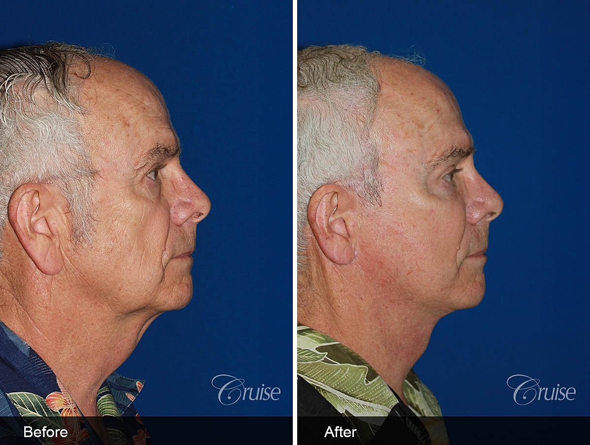 Face Lift Before & After