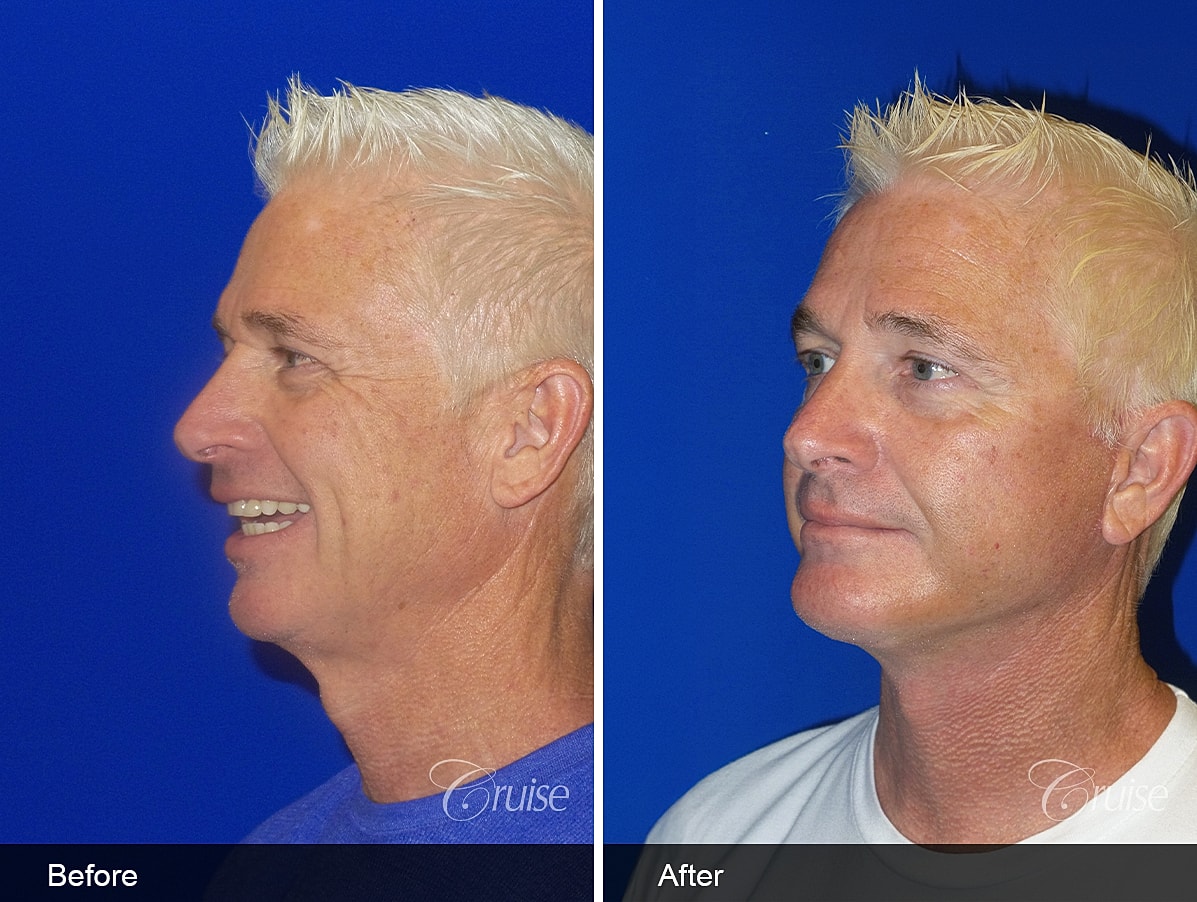 Face Lift Before & After