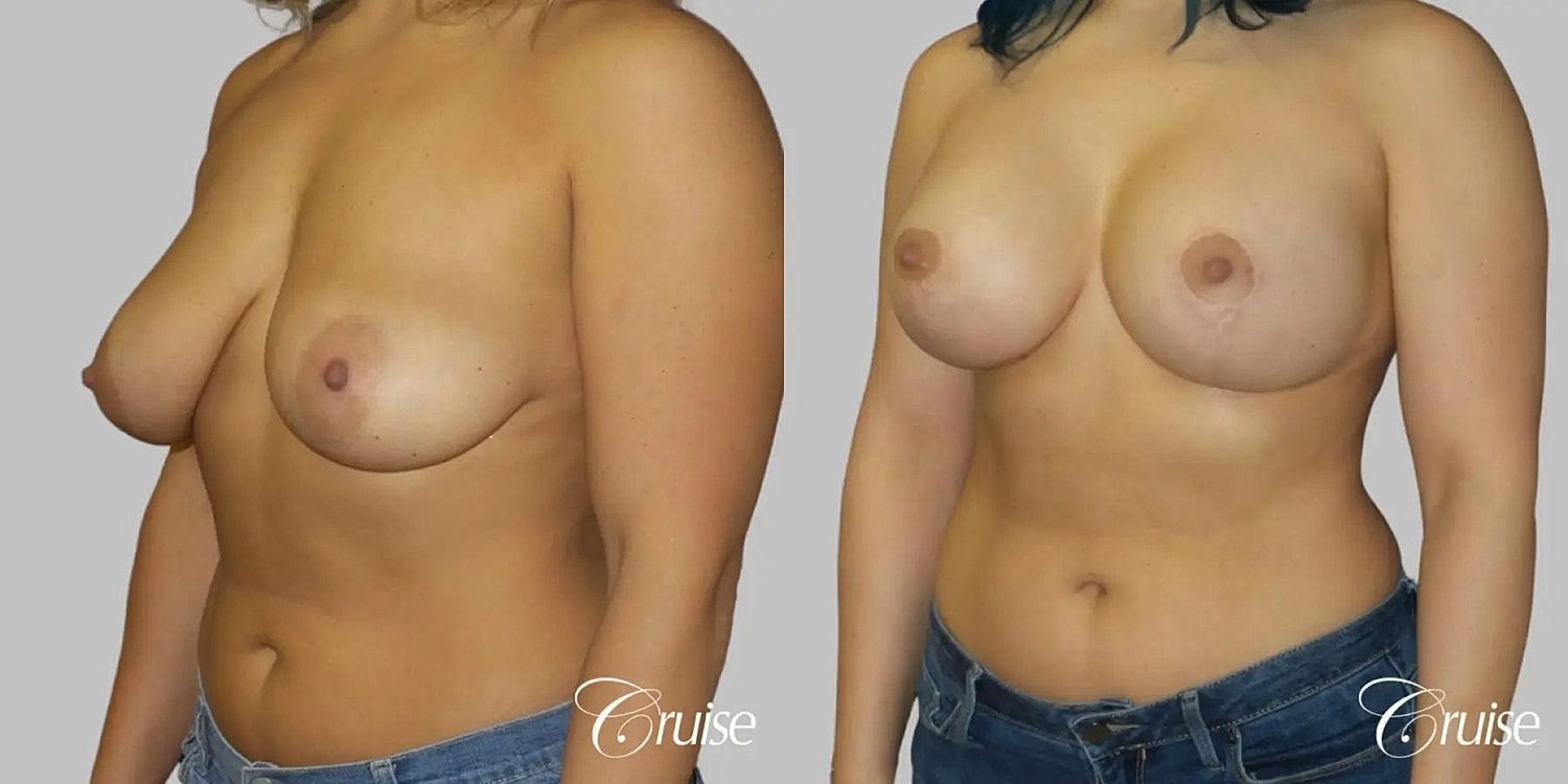 Breast Lift Augmentation Before & After
