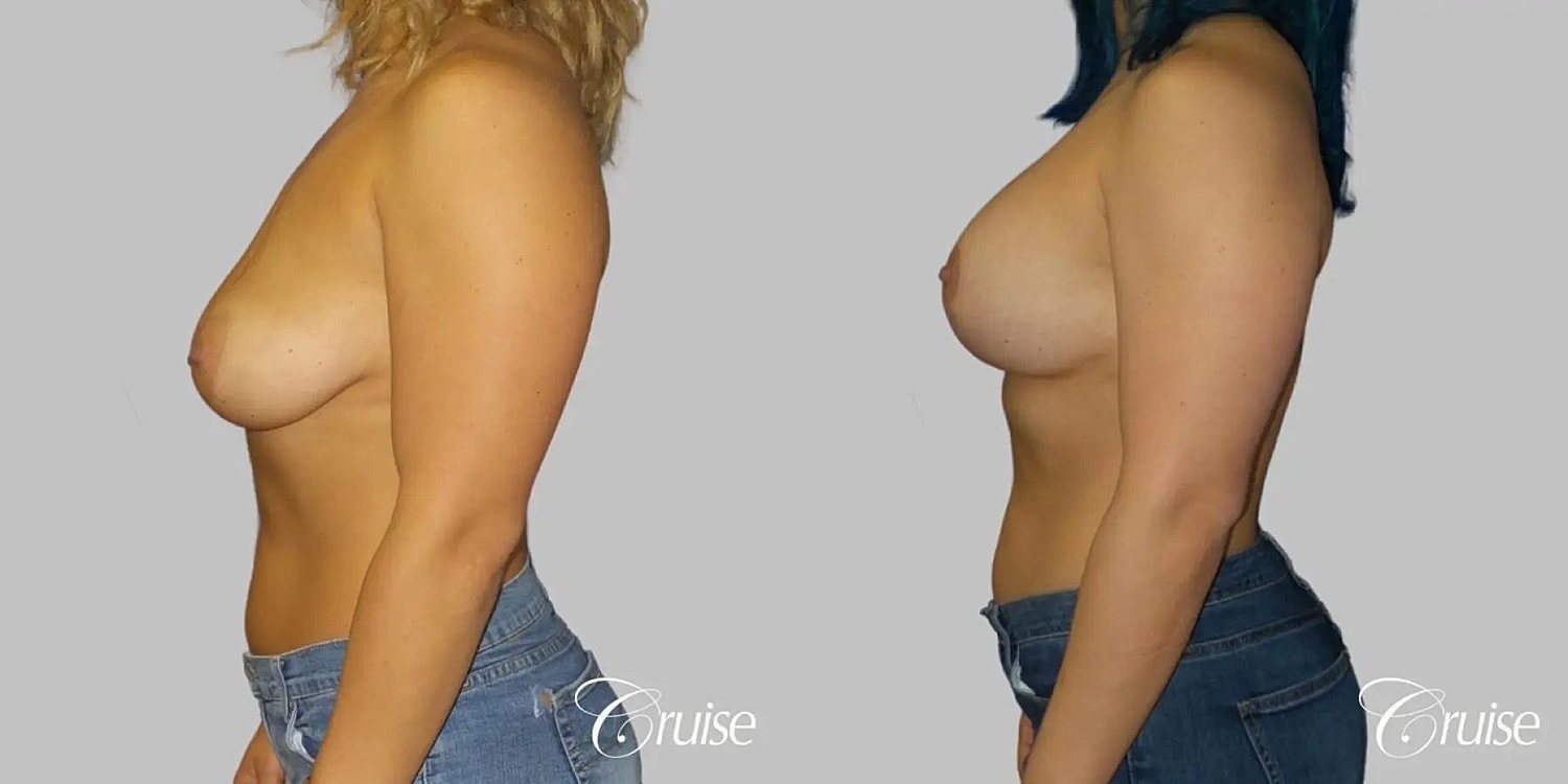 Breast Lift Augmentation Before & After