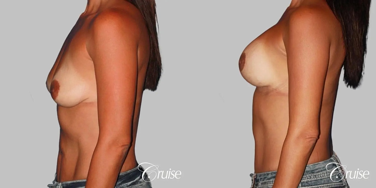 Breast Lift Augmentation Before & After